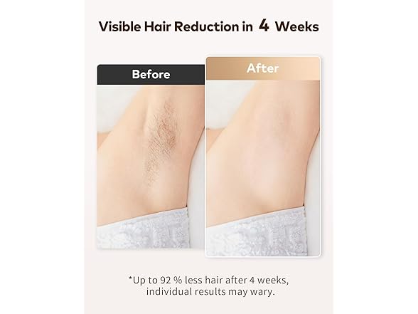 LYSMOSKI LYSMOSKI Laser Hair Removal for Women an