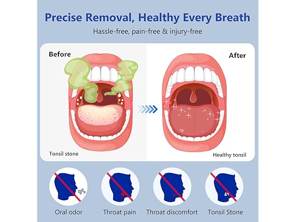 SIQIONG Electric Tonsil Stone Remover - Gallery 5