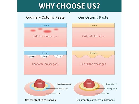 ovand Ostomy Filler Paste for Ostomy