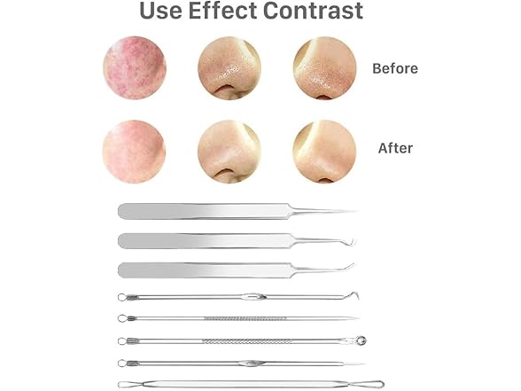 Pinkiou Blackhead Remover Comedone Pimple Popper Tool 