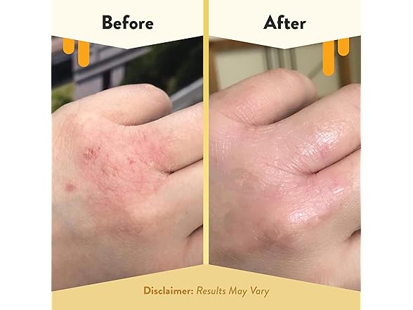 ECZEMA HONEY Original Skin-Soothing Crea