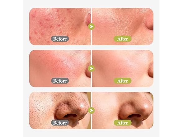 Hyuxeo Salicylic Acid Serum for Acne