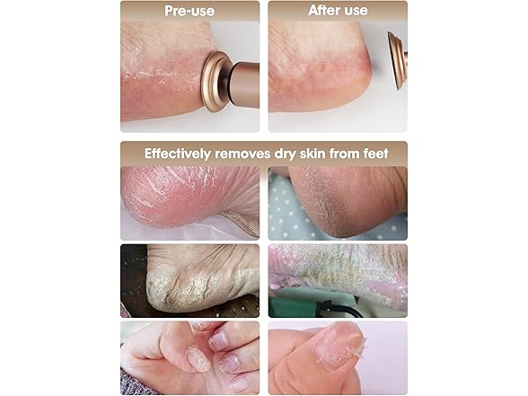 KIUCID Electric Foot Callus Remover  (Rose Gold)