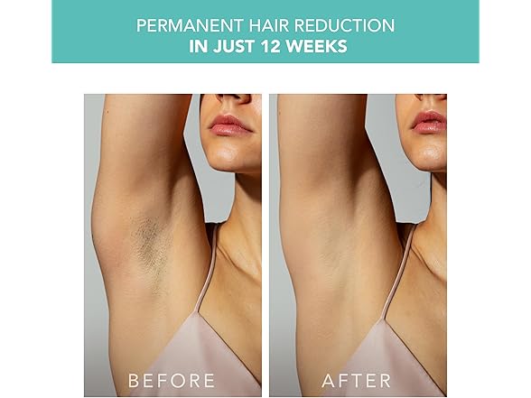 FOREO PEACH 2 IPL Hair Removal Device