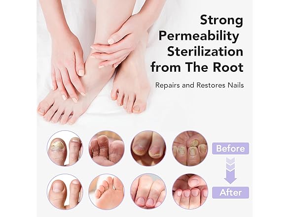 ourui one Toenail Fungus Treatment