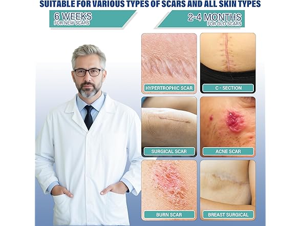 mitreal Silicone Scar Sheets