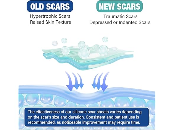 mitreal Silicone Scar Sheets