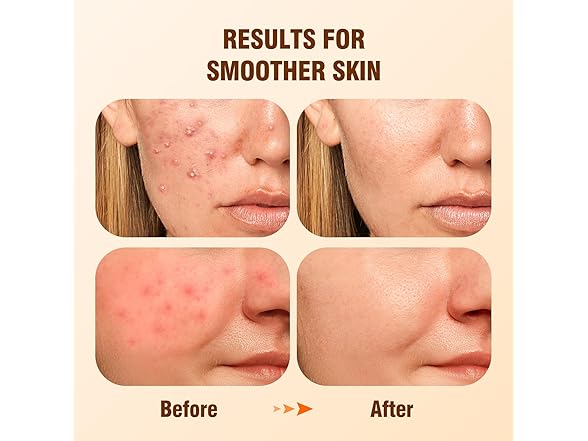 Salicylic Acid 2% Serum Solution