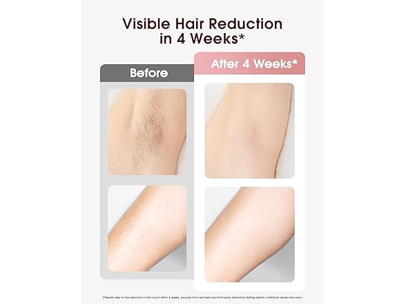 LYSMOSKI Ice Cooling Laser Hair Removal