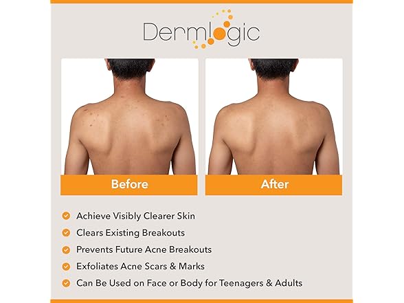Dermlogic Acne Treatment