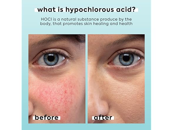 Hypochlorous Acid Spray for Face and Body