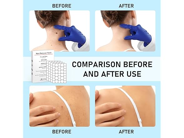 WABRINY Wart Remover Patches