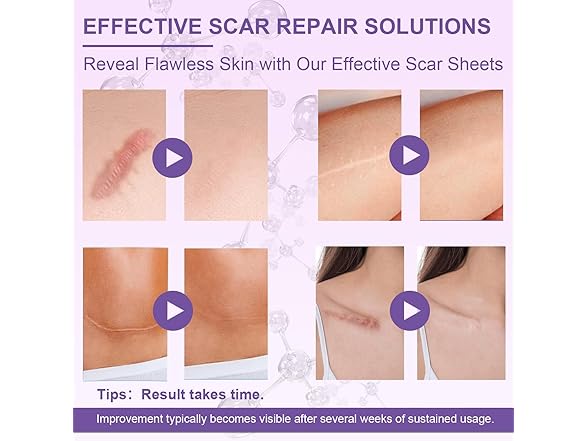 LUXEFUS Silicone Scar Tape