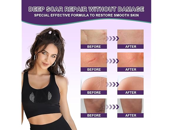 Tearich Scar Cream Gel