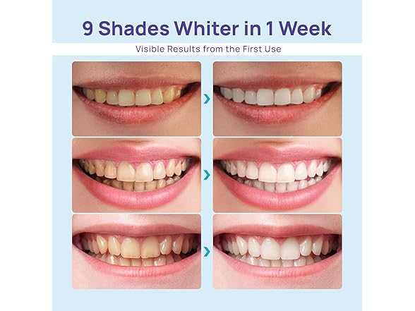Whitebite Pro teeth whitening kit