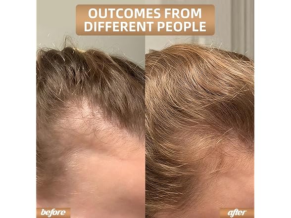 Carviki BC5385260162481 hair growth cap