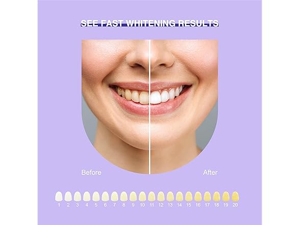 LUXSMILE Teeth Whitening Kit