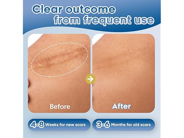 Glowor Advanced Silicone Scar Gel