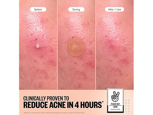 PEACE OUT Acne Healing Dots