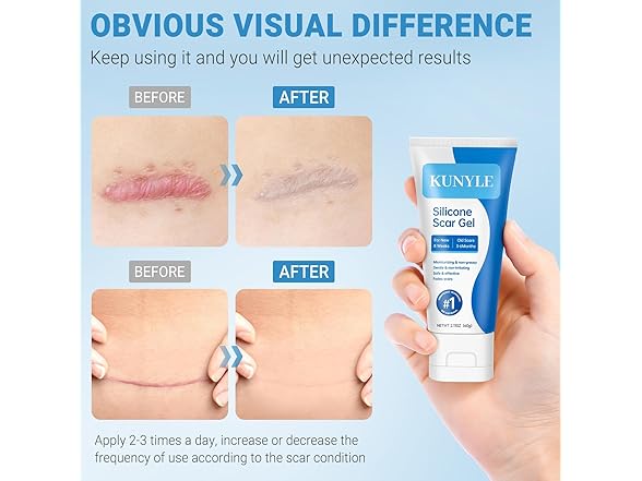 Kunyle BC521525100038 silicone scar gel