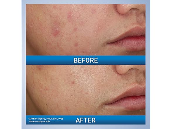 CeraVe Acne Foaming Cream Wash