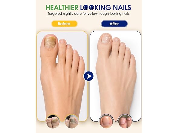 COFUMAY Fungal Nail Patches