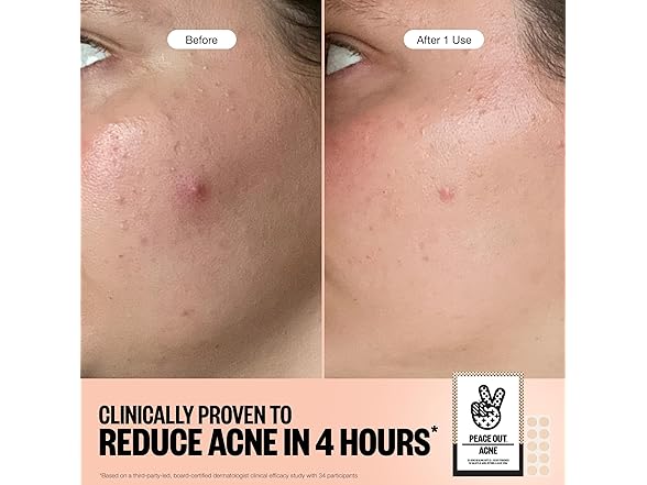 PEACE OUT Acne Healing Dots