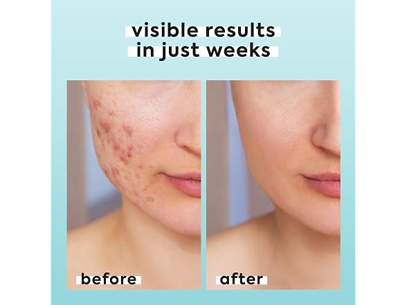 Hypochlorous Acid Spray for Face and Body
