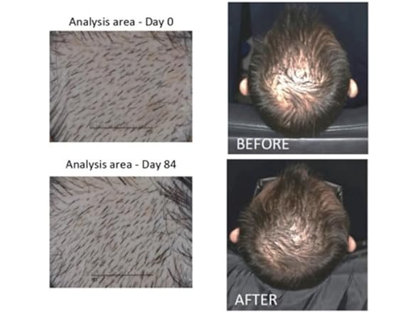 Actsyl-3 Hair Growth Serum with Redensy