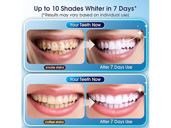 Teeth Whitening Kit with LED Light