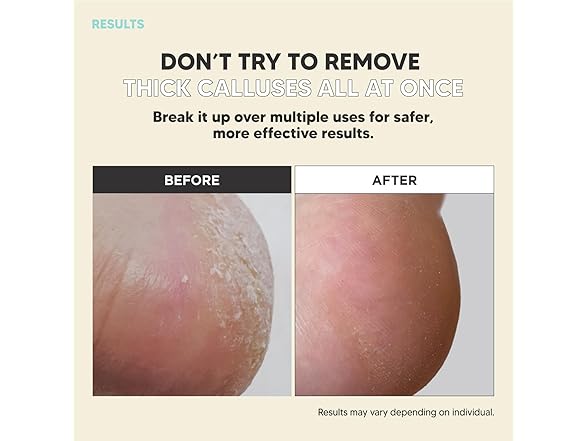 F3 Systems Callus Razor, Pedicure Tool