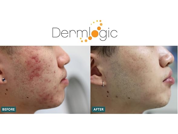 Dermlogic Acne Treatment
