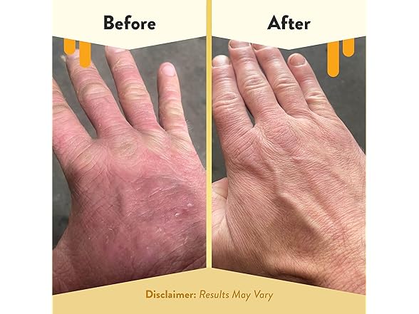 Eczema Honey Gentle Foaming Hand Soap 8.4oz