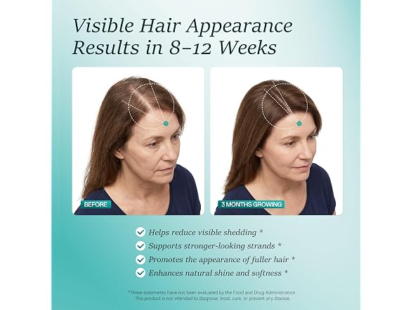 Wiltormin Hair Growth Supplements